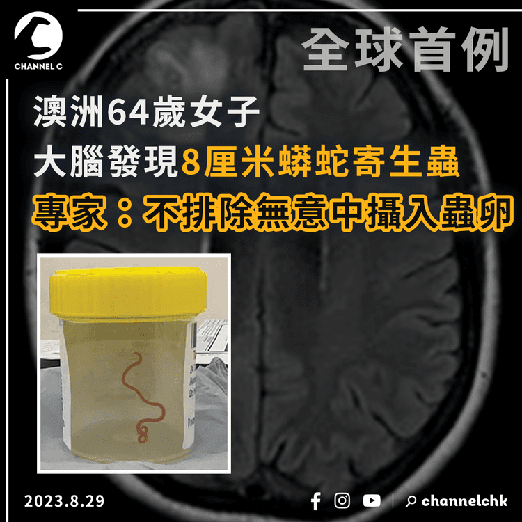 全球首例︱澳洲64歲女子大腦發現8厘米蟒蛇寄生蟲　專家：不排除無意中攝入蟲卵