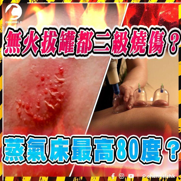 北上按摩慎選！港女拔罐遭二級燒傷 記者親身實測艾床：女仔皮薄燒傷唔出奇 中醫稱有港人因按摩致痙攣 肌肉外露移位