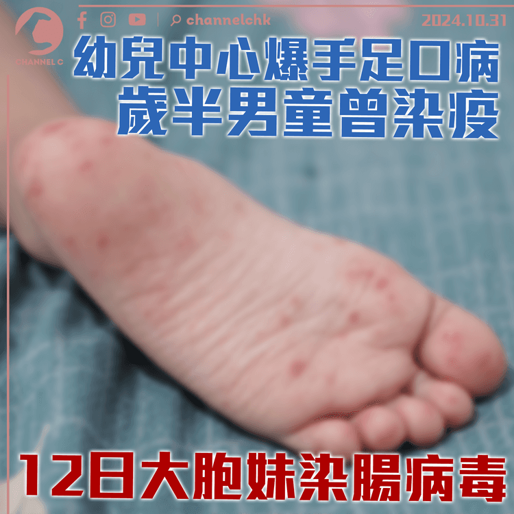 幼兒中心爆手足口病　歲半男童曾染疫　12日大胞妹染腸病毒