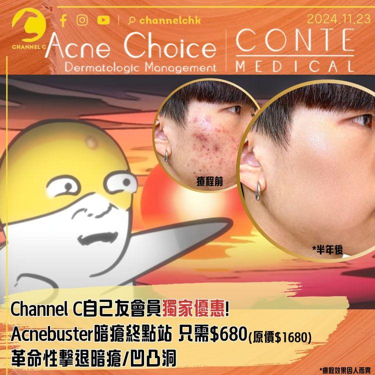 🔴【 #ChannelCHK 會員優惠】🥳　助你擊退暗瘡凹凸洞