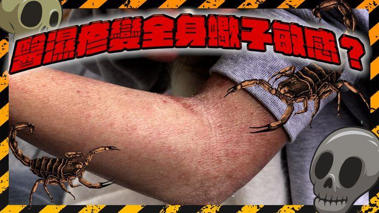 女生關節位醫濕疹變蠍子敏感 全身出水發紅 涉事中醫出律師信拒賠