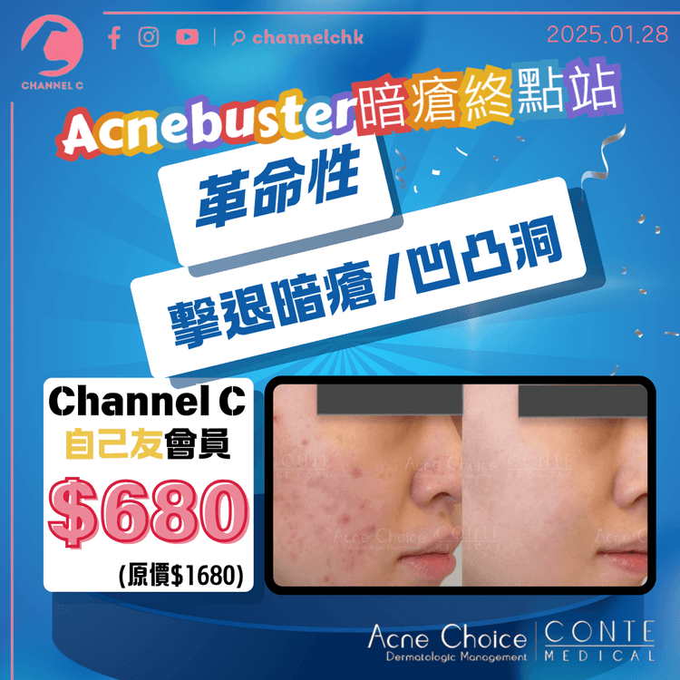 【#ChannelCHK 自己友推介】 「Acnebuster 暗瘡終點站綜合治療」三合一技術