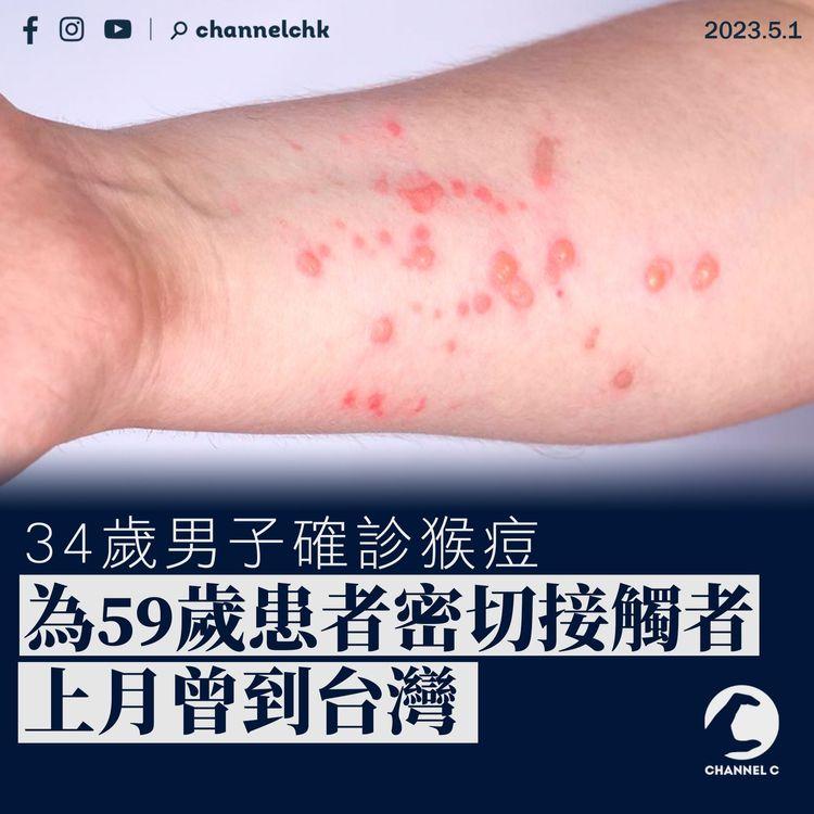 34歲男子確診猴痘 為59歲患者密切接觸者 上月曾到台灣