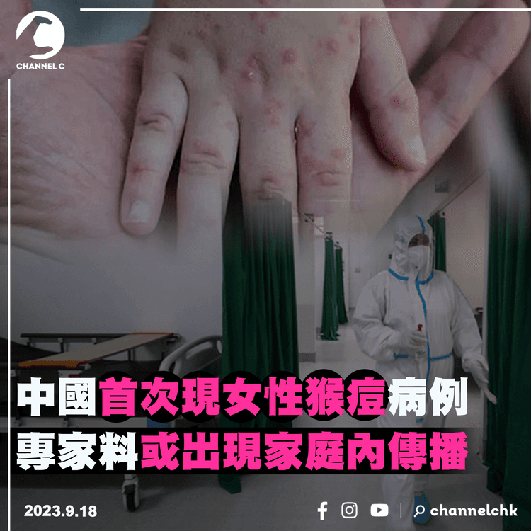 中國首次發現女性猴痘病例　專家料或出現家庭內傳播